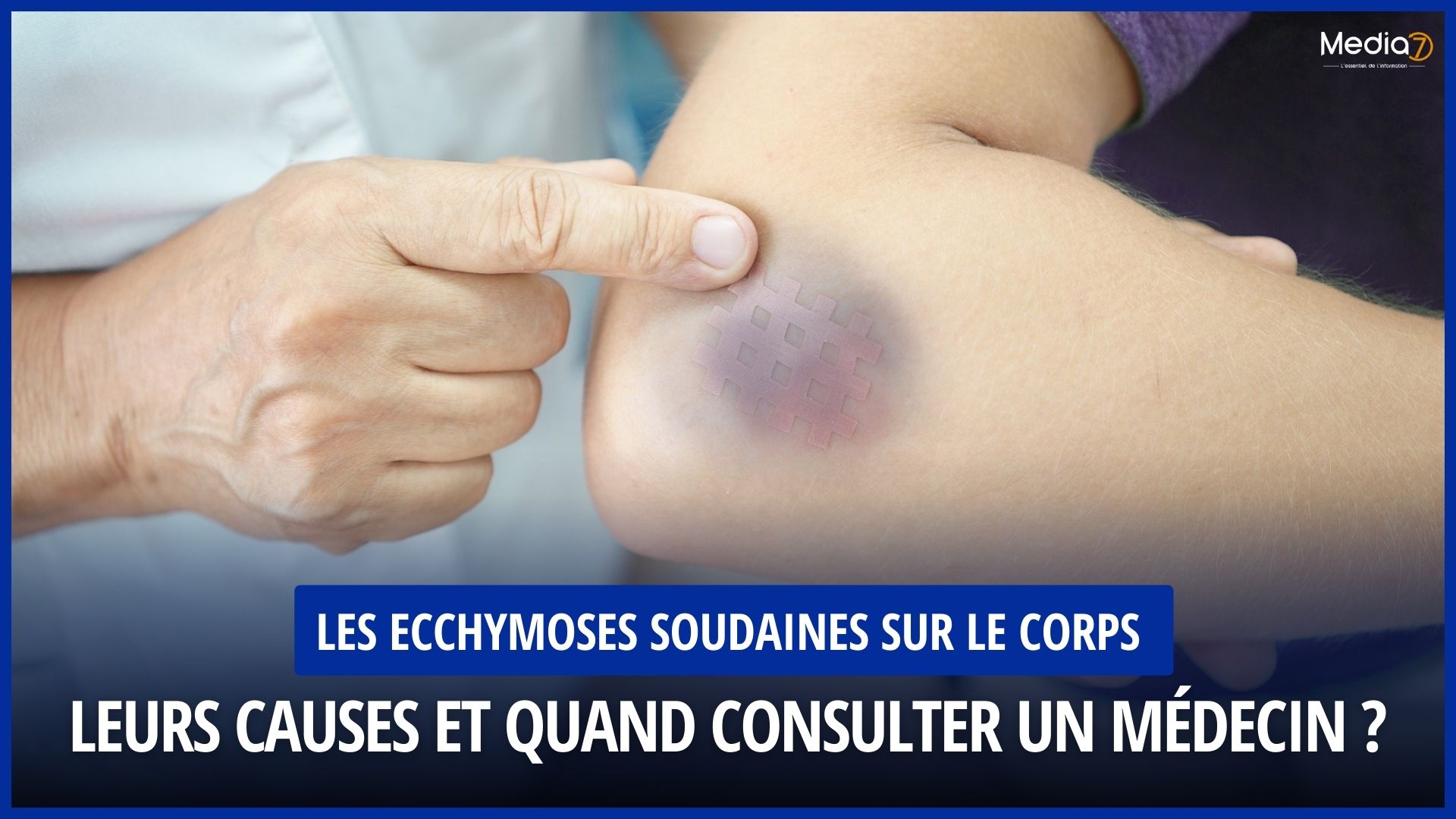 Les Ecchymoses Soudaines sur le Corps