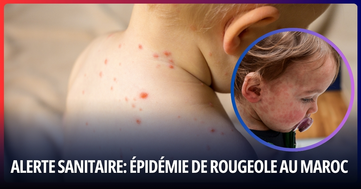 Épidémie de Rougeole au Maroc