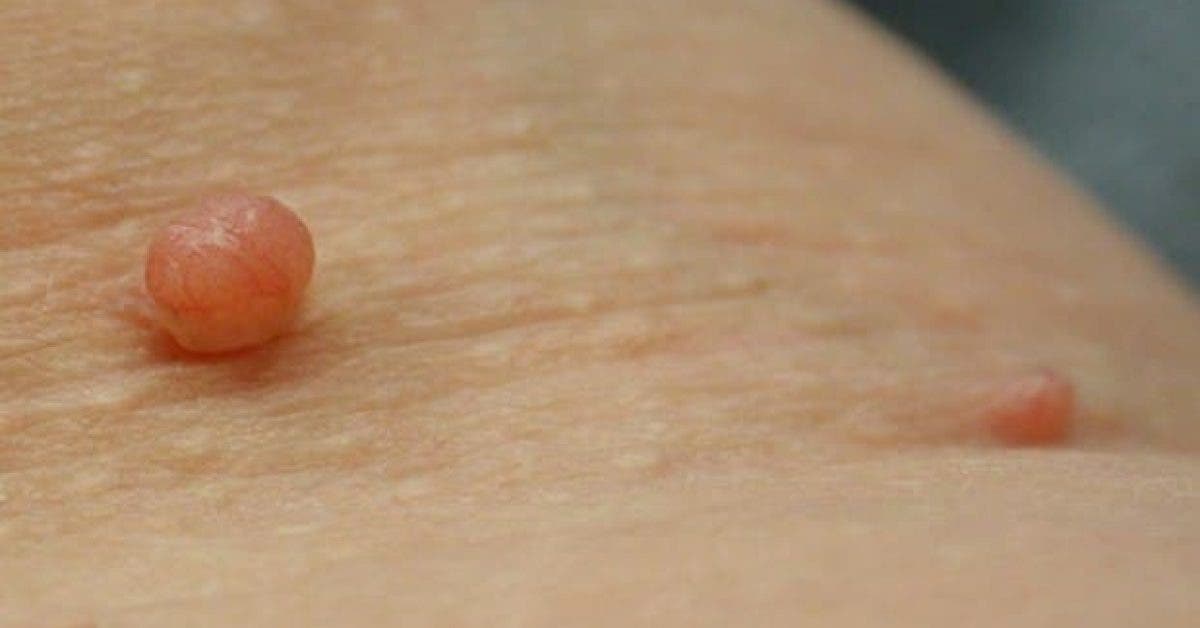 Remèdes Naturels pour Éliminer les Acrochordons