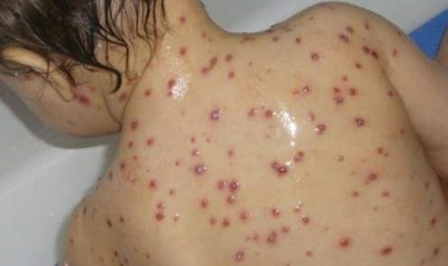 Alerte Rougeole au Maroc : Bouhamroun Frappe Fort