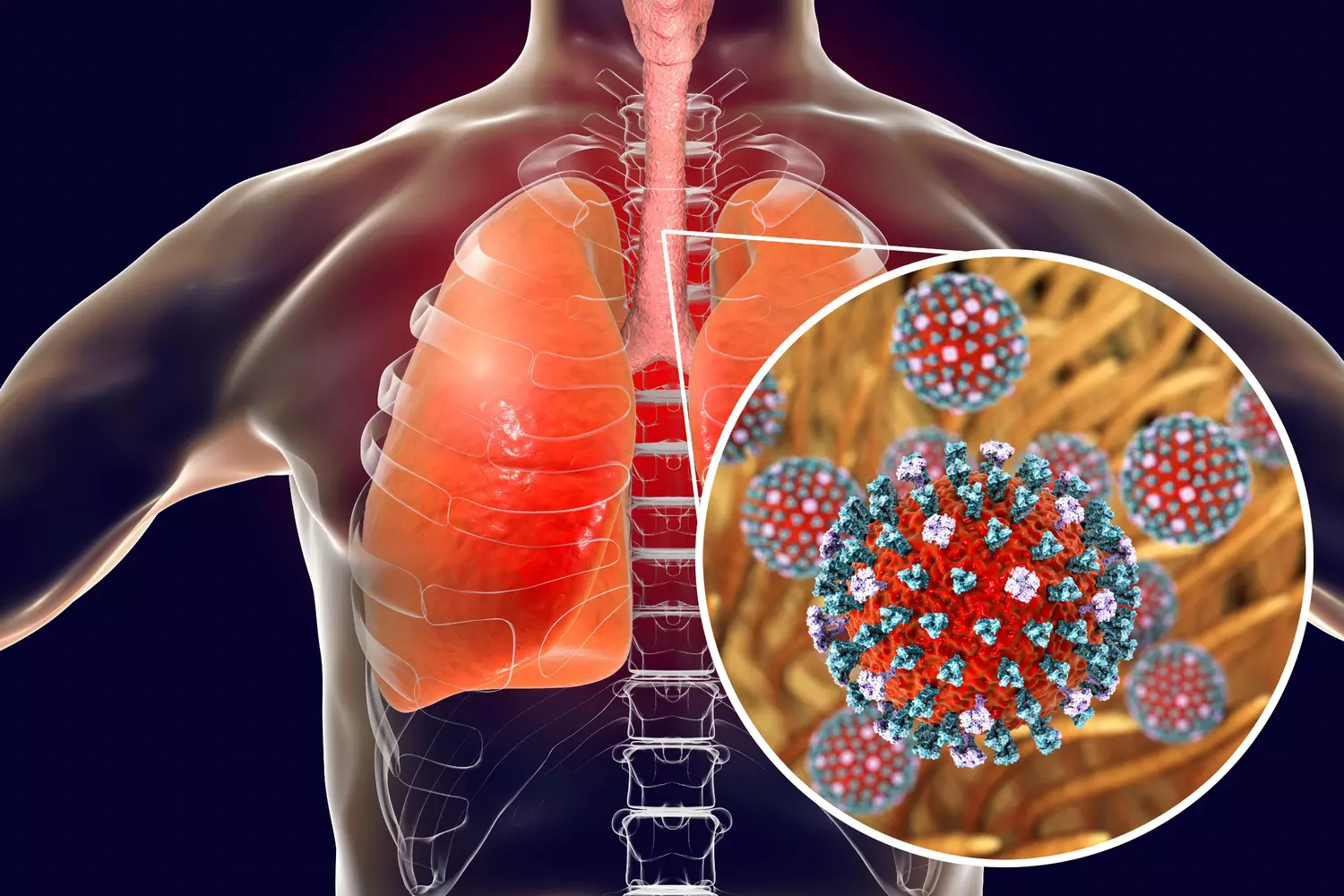 La «Super-Grippe» H3N2 Mutante Dégaine Plus Tôt : Que Savoir Pour Vous Protéger? 2 Super-Grippe