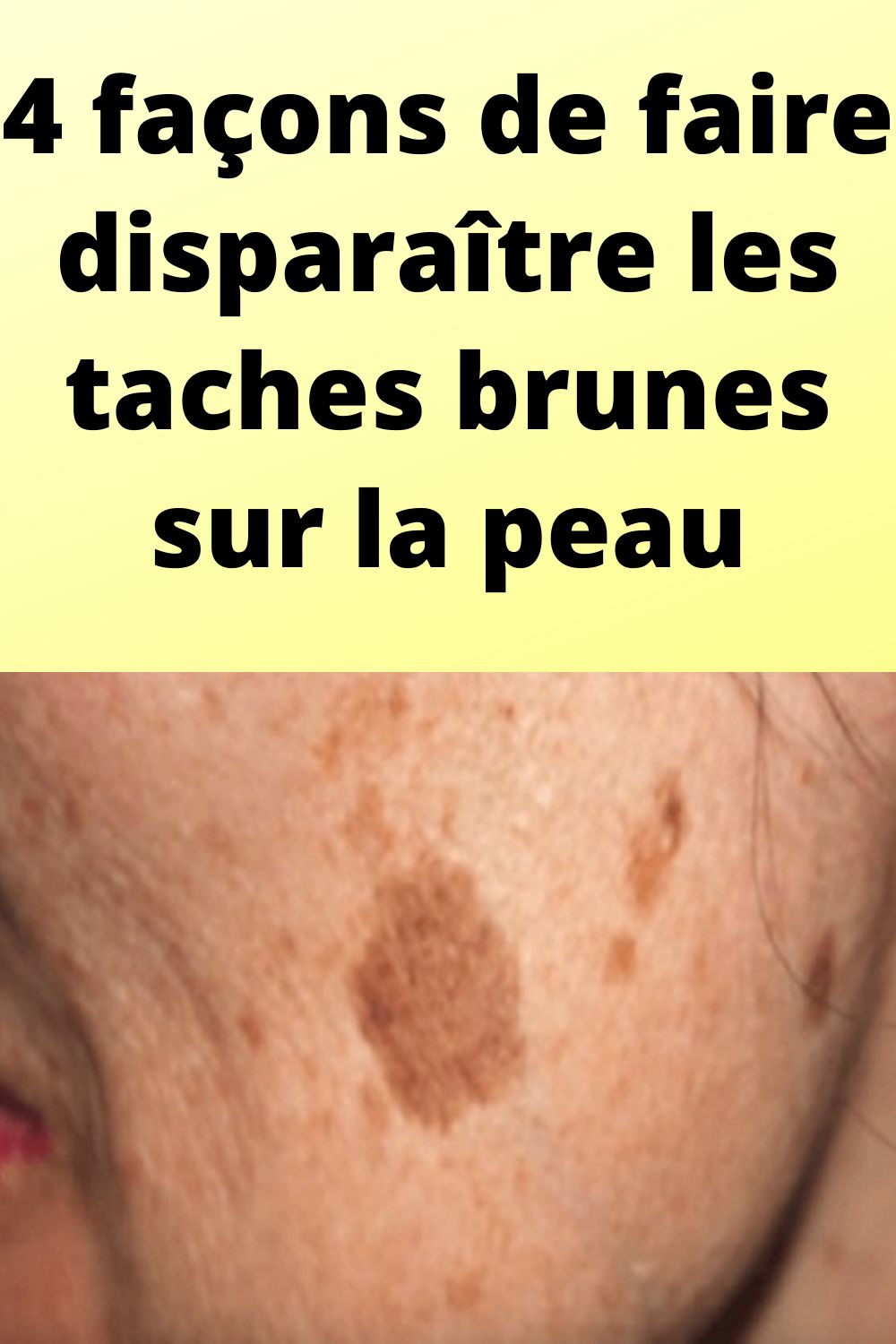4 façons de faire disparaître les taches brunes sur la peau 2 4 façons de faire disparaître les taches brunes sur la peau
