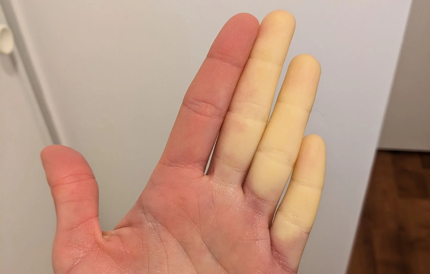 Maladie de Raynaud : remède de grand-mère naturel pour réchauffer les mains et améliorer la circulation sanguine