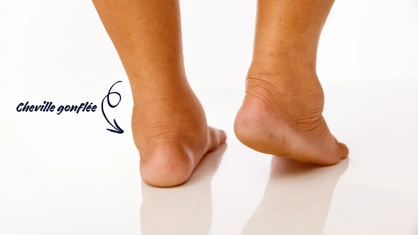 Pieds et chevilles gonflés