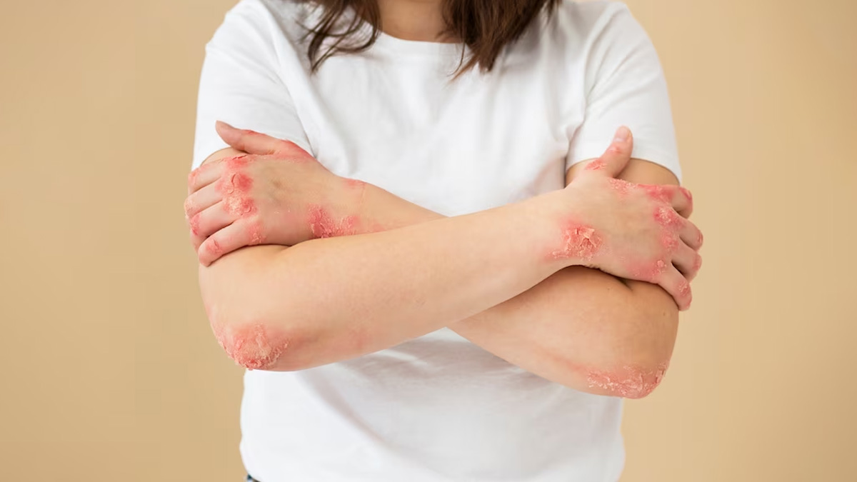 Signes avant-coureurs du LUPUS que vous devez connaître (ET QUAND VOUS LES FAIRE !) 4 Signes avant-coureurs du LUPUS que vous devez connaître (ET QUAND VOUS LES FAIRE !)