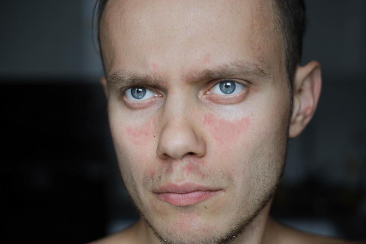 Signes avant-coureurs du LUPUS que vous devez connaître (ET QUAND VOUS LES FAIRE !) 2 Signes avant-coureurs du LUPUS que vous devez connaître (ET QUAND VOUS LES FAIRE !)