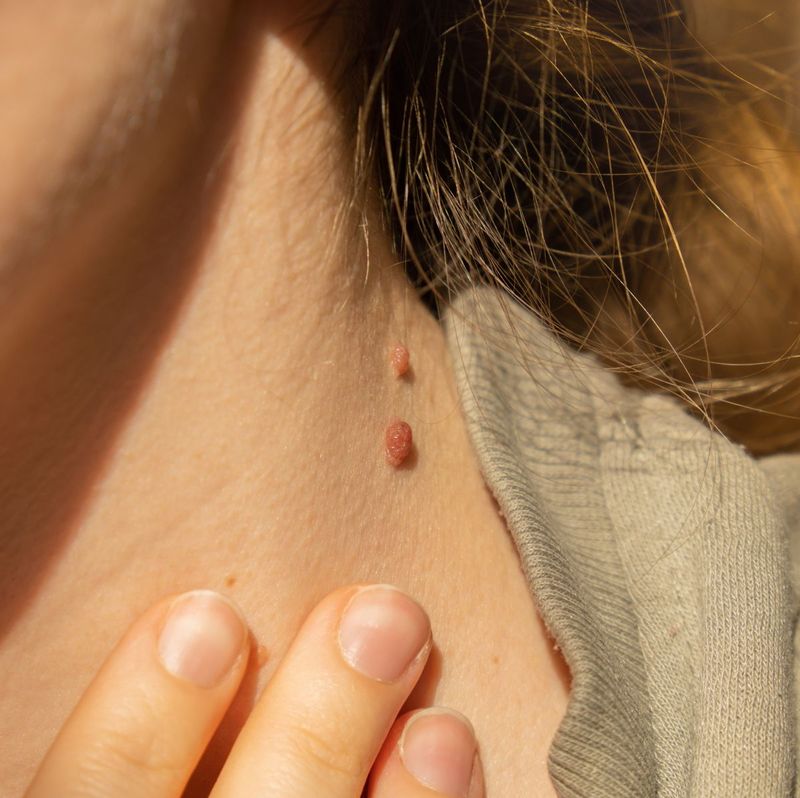 Faites disparaître vos acrochordons: avec cette solution naturelle, ils tomberont en une semaine! 2 Faites disparaître vos acrochordons: avec cette solution naturelle, ils tomberont en une semaine!