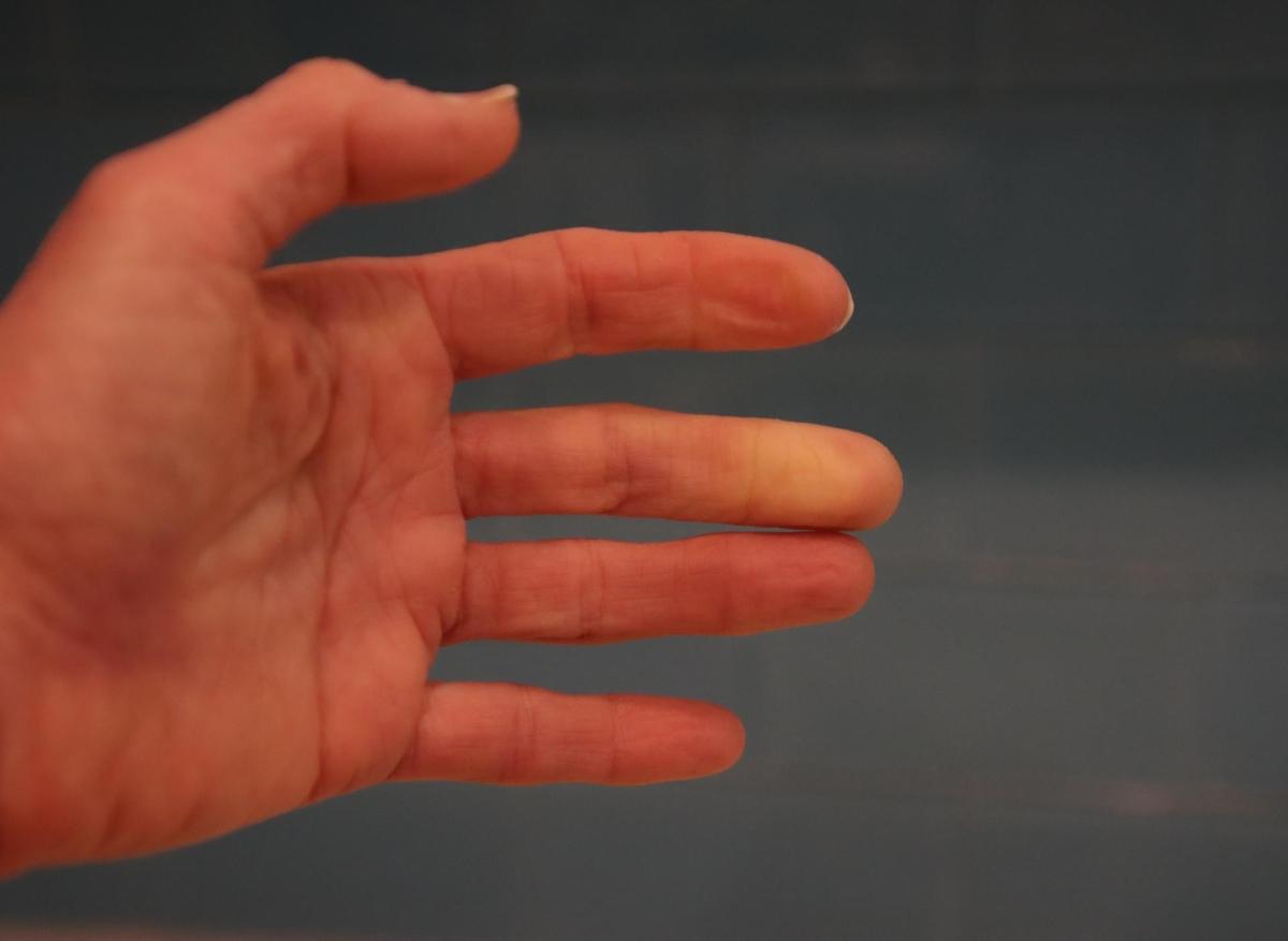 Maladie de Raynaud : remède de grand-mère naturel pour réchauffer les mains et améliorer la circulation sanguine 3 Maladie de Raynaud : remède de grand-mère naturel pour réchauffer les mains et améliorer la circulation sanguine