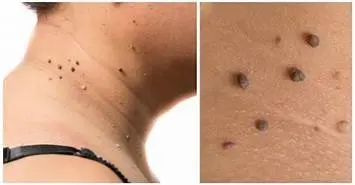 Comment faire disparaître naturellement vos acrochordons en une semaine 2 Comment faire disparaître naturellement vos acrochordons en une semaine