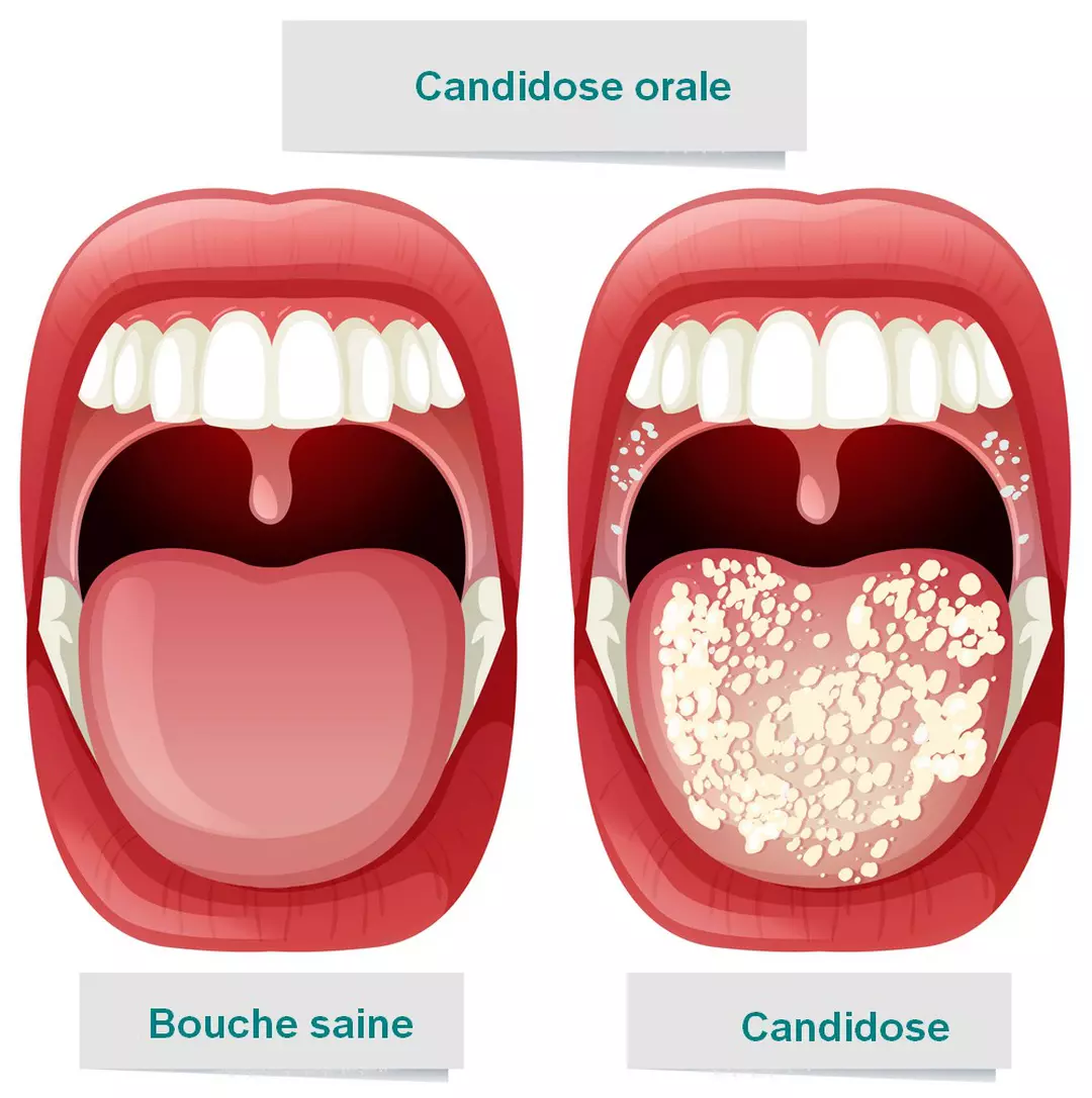 Mycose de la bouche : 7 solutions naturelles pour retrouver le sourire rapidement 2 Mycose de la bouche