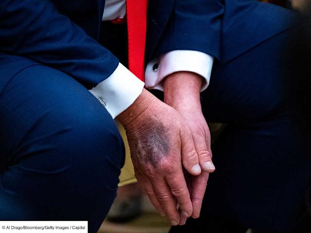 Donald Trump lève le voile sur les hématomes qui intriguent