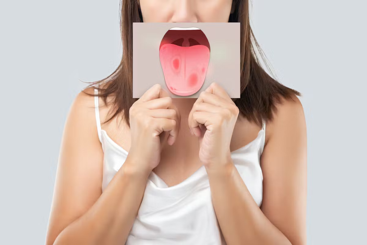 Mycose de la bouche : 7 solutions naturelles pour retrouver le sourire rapidement 3 Mycose de la bouche