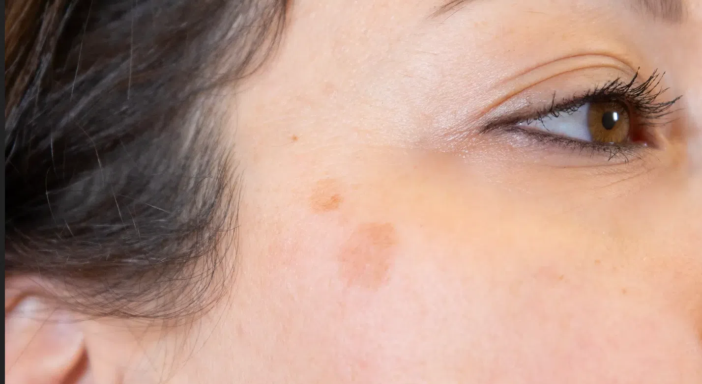 Éliminez Les Taches Brunes Sur Votre Visage : Les Méthodes Qui Fonctionnent Vraiment 2 Éliminez Les Taches Brunes Sur Votre Visage