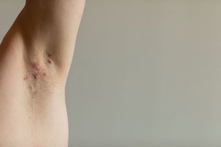 Maladie de Verneuil : tout ce qu'on ne vous dit pas sur l'Hidradénite Suppurée