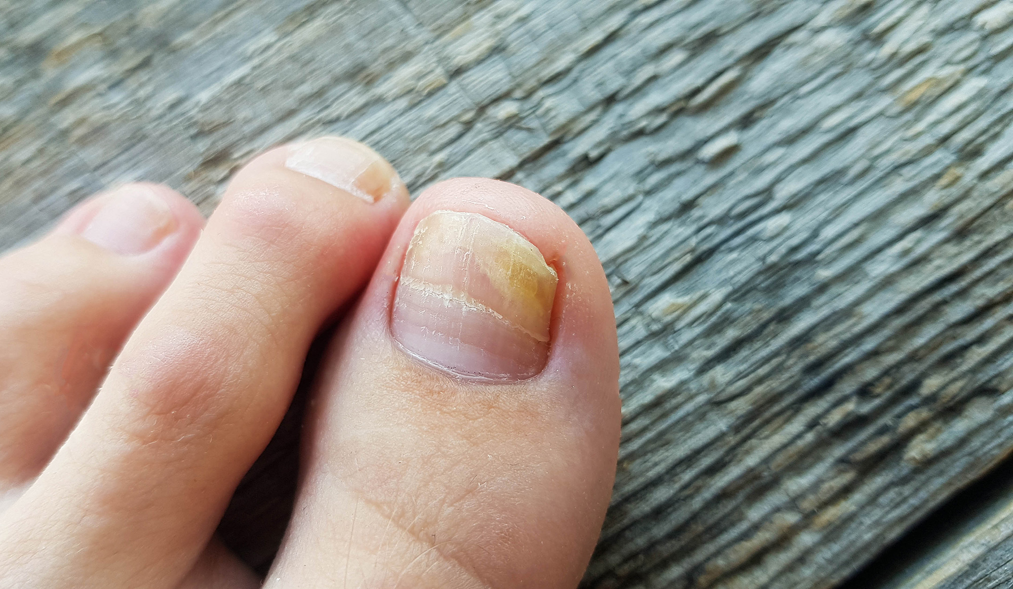 Remède de grand mère pour soigner les mycoses des ongles de pieds 2 mycose des ongles de pieds