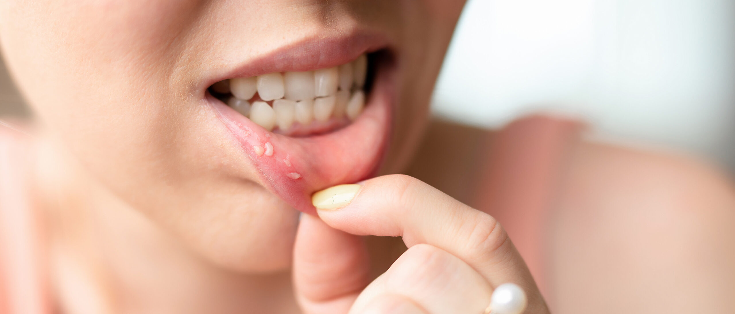 Comment soigner un aphte rapidement ? 7 remèdes maison infallibles pour en finir avec la douleur 2 soigner un aphte rapidement